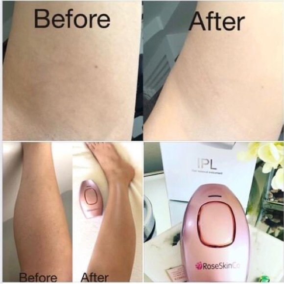 Happy Skin IPL Hair Removal - Picture 3 of 7